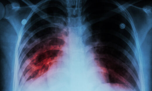 Should I Be Concerned About Tuberculosis?