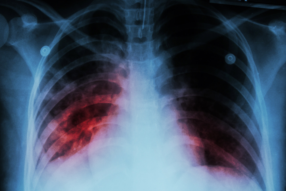 Should I Be Concerned About Tuberculosis?